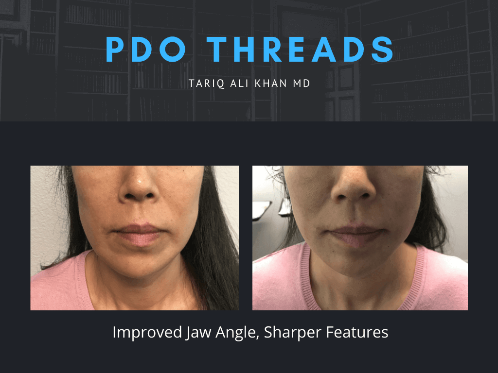 Gentle Care Laser Tustin & Long Beach Before and After picture - PDO Threads